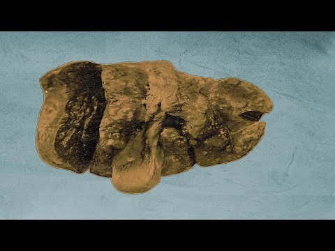 Leftover pasta causes food poisoning and kills college student