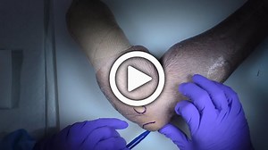 Coronoid Fixation Using a Coronoid Plate with Thomas Goetz, MD