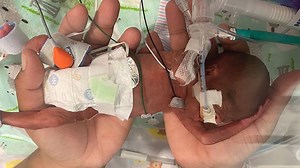 Baby born at 21 weeks named world’s most premature infant to survive