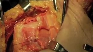 Anterior approach to the Glenoid