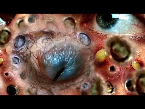 plucking Facial Huge HAIR Remove ASMR