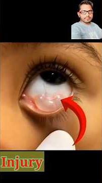 Conjunctival Cyst: Causes, Symptoms & Treatment#healthknowledge #shortsfeed #dental #doctor #eye