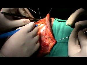 Radical Neck Dissection (HD)- Head Neck Surgery- Dr Rajnish Talwar