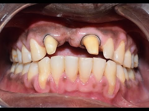 Ceramic Crown and Bridge - Crown Preparation | Impression Techniques | Temporary crown.