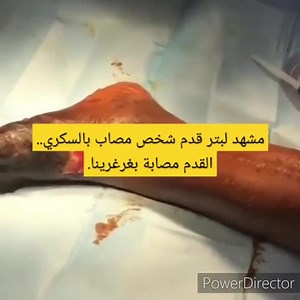 Diabetic Foot Amputation