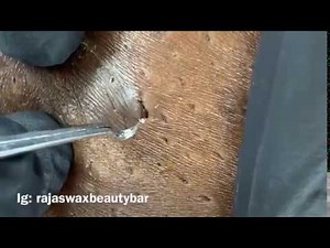 Extraction from bikini area!!