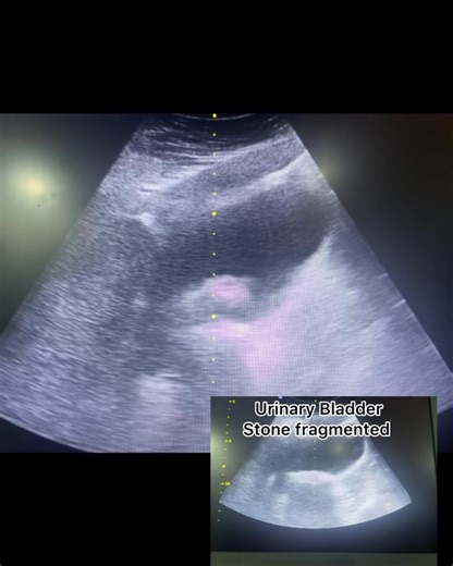 Another successful urinary bladder stone treatment with shockwave lithotripsy. Safe, effective, and non-invasive. (For urinary stones, not gallstones.) | Kidney Stone and Shockwave Urology Manila