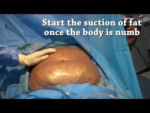 How is liposuction performed? | Centre for Surgery