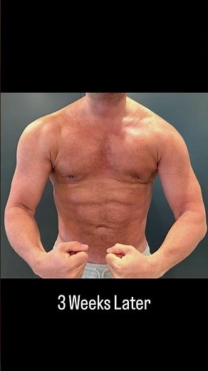 Pre-O vs. 3 Weeks Post-Op #bodytransformation #results #male #change #plasticsurgery #beforeandafter