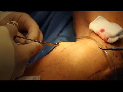 Microstab Phlebectomy // Varicose Vein Removal