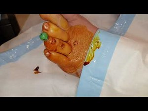 Pulling out #surgical #Pin from a #broken #toe