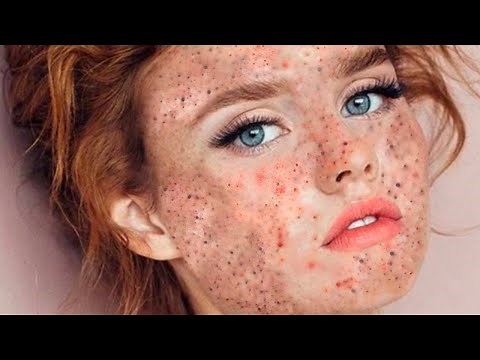 Pimple Popper & Blackhead Removal | Best Pimple Popping Compilation 2024 Video 10