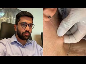 One Small Neck Cyst, One Satisfying Removal