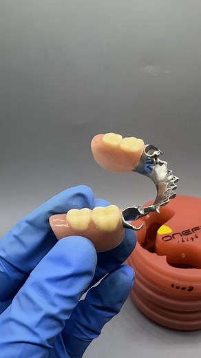 Metal partials #dentistrymyworld #digitaldentallab #DentalInnovation #Dentistry #3shape | 詹文海