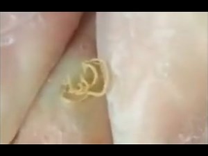 HUGE CYST Extracted (CYST Removal Videos 2022) / #7