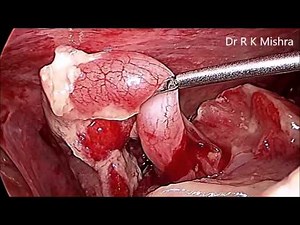 Laparoscopic Management of Rupture Pediatric Appendix in Pediatric Patient
