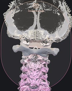The atlas is the first cervical vertebra (C1). It is classified as an atypical cervical vertebra because it lacks a vertebral body. Besides that, it also does not have a spinous process. 💡 Instead of a vertebral body, the atlas has an additional arch named the anterior arch. Therefore, the first cervical vertebra is easily recognizable by the presence of two vertebral arches that are interconnected by two lateral masses. 😎 Additionally, each arch shows a round bony protrusion called a tubercle