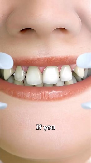 How Braces Straighten Your Teeth #reels | Morris Macgregor