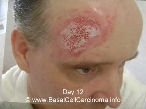 Time lapse video and pictures of Basal Cell Carcinoma removal (skin cancer) treatment, no surgery