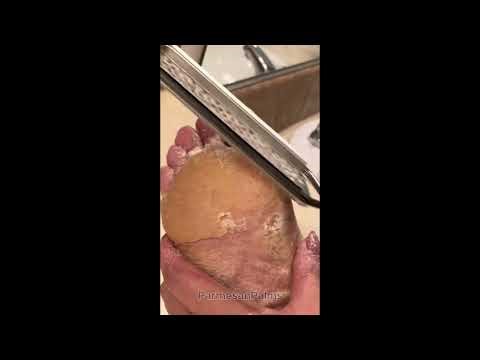 EXTREME CALLUS REMOVAL || Whole Foot Transformation || FOOTCARE || Foot Spa