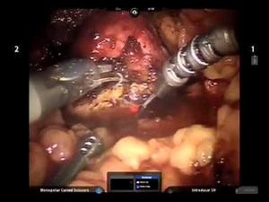 Robotic Laser Partial Nephrectomy • Video • MEDtube.net