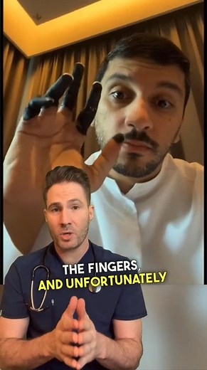 Severe frostbite to fingers leading to amputation. #frostbite #amputation #nofingers #hypothermia #doctor | Doctor Joe