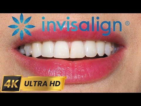 TRAILER of Invisalign Treatment - Deep Overbite and Gummy Smile!