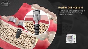 <SQ GUIDE> DENTIS DIGITAL GUIDE SYSTEM for SQ Implant Enjoy simply, safely, perfectly! ▶ Drill design for perfect irrigation ▶ Simple protocol ▶ Titanium sleeve ▶ SQ exclusive Place the implant in the correct position by virtually doing the implant placement through the software. #DIGITALGUIDE #GUIDE #DENTISGUIDE #SQ | DENTIS Implant