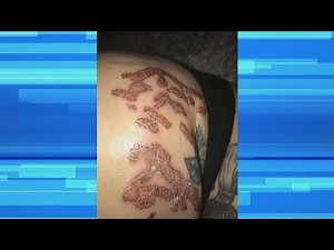 Stretch Mark Procedure Gone Wrong!