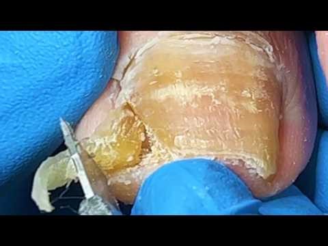 The Patient Said That The Toes Hurt! I Pulled Out The Nail In An Instant【Xue Yidao】