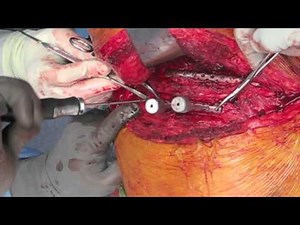 Operative fixation of flail chest (multiple rib fractures)