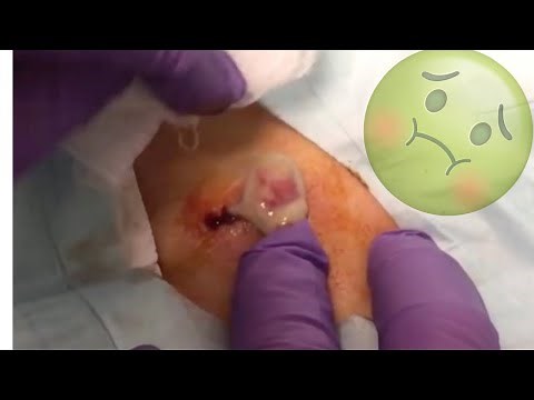 Oddly Satisfying Cyst Popping Compilation
