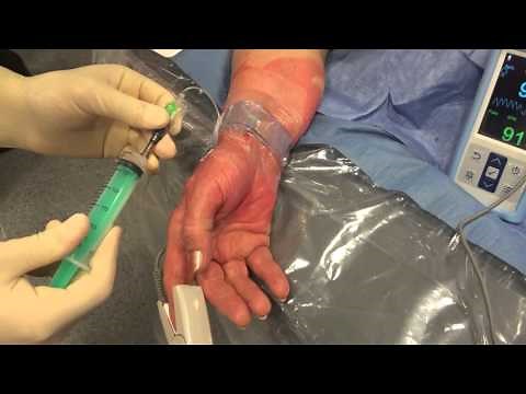 Patent Haemostasis with TR Band