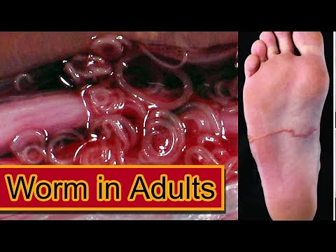 Understanding Worm Infections in adults: Symptoms, and Treatments