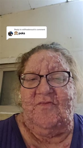 Replying to @willhasbrouck #NOTmonkeypox #NF #neurofibromatosis #CTF #Geneticdisorder