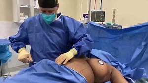 Buttock Reconstruction with a Brazilian Buttock Lift or BBL after Silicone Injection Removal