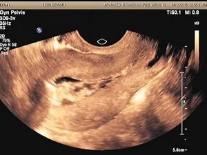Sono HSG Procedure with ABBI showing bubbles in the uterus