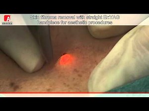 SKIN FIBROMA REMOVAL Fotona Lightwalker Er:YAG laser