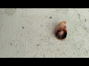 Pulp Polyp | Chronic Hyperplastic Pulpitis