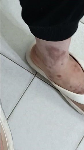 Tinea Pedis