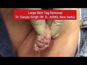 Large Skin Tag Removal #skintags #skintag #skintagremoval #skintagsremoval #wartstreatment #skincare