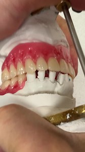 Upper and Lower Wax Try-In. Case from Dr. Ronald Ritsert in Illinois. | LSK121 Oral Prosthetics
