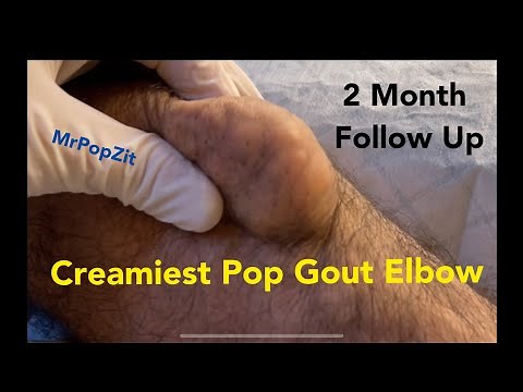 Creamiest Pop Gout Elbow 2 month Follow Up. Patient so happy with results and pain free. Link below