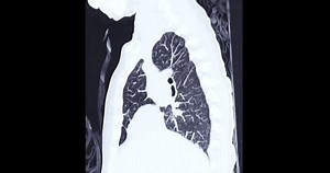 Ct Chest Ct Scan Lung Sagittal Stock Footage Video (100% Royalty-free) 1094184533 | Shutterstock