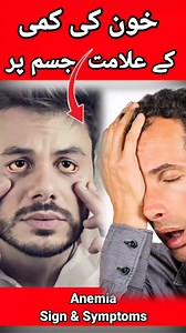 14K views · 522 reactions | Anemia Blood deficiency in Body By Dr Mustaqeem Medical information and awareness Video in Urdu/Hindi خون کی کمی کے علامات جسم پر؟ #anemia #blood #deficiency #body #drmustaqeem #medical #information #awarness #urdu #hindi | Dr. Mustaqeem | Facebook