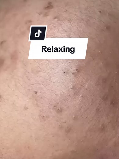 Satisfying Blackhead Removal Videos