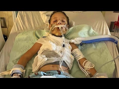 Little Girl Burned by Bursting NeeDoh Squishy Toy