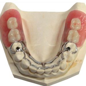 [Hot Item] Restauraciones dentales removibles en venta, dentaduras flexibles completas y parciales, dientes láser, estructura dental BPS, dientes terminados completos