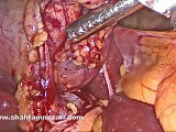 Laparoscopic Cholecystectomy Arterial and Ductal Dissection • Video • MEDtube.net