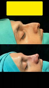 How do you fix a crooked nose deformity? Septoplasty helps to straighten your nose by reshaping the wall between your nasal passages. If you have a crooked nose due to a deviated septum, your doctor will likely recommend septoplasty. In addition to straightening your nose, septoplasty can also relieve nasal airway blockage caused by a deviated septum. #RhinoplastyPakistan #NoseSurgeryPakistan #NoseJobPakistan #BeautifulNosePakistan #ConfidentNosePakistan #RhinoplastyLahore #NoseSurgeryKarachi #N